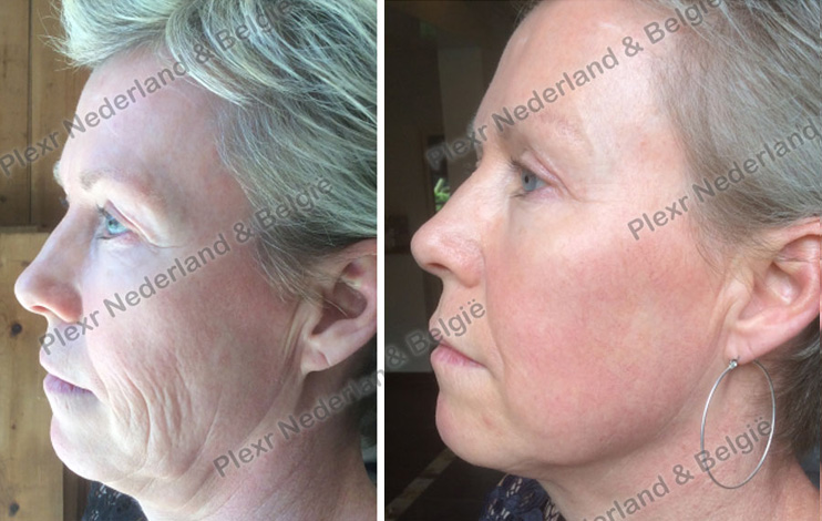 HLH Facelift